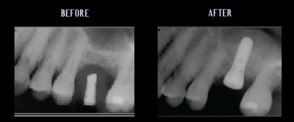 Single Tooth Implant Placement