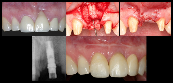 Bone Reconstruction and Implant Placement