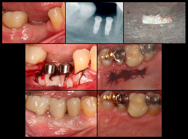 Implant Placement and Tissue Graft from palate around the implant
